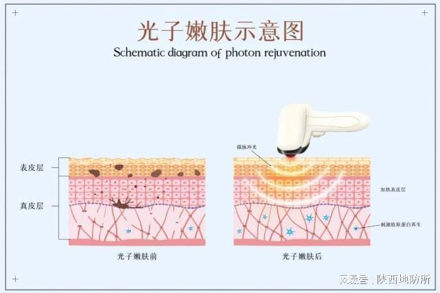 光子嫩肤三大美肤原理