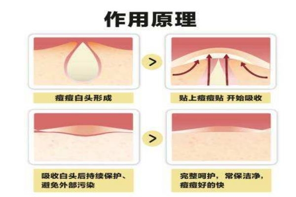 痘痘贴的工作原理有什么 痘痘贴应该怎么用呢